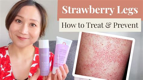 Strawberry Legs Get Rid Of Them And Prevent Them Like A Dermatologist