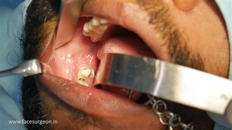 surgical wisdom tooth extraction by specialist oral surgeon dr sunil richardson dental clinic