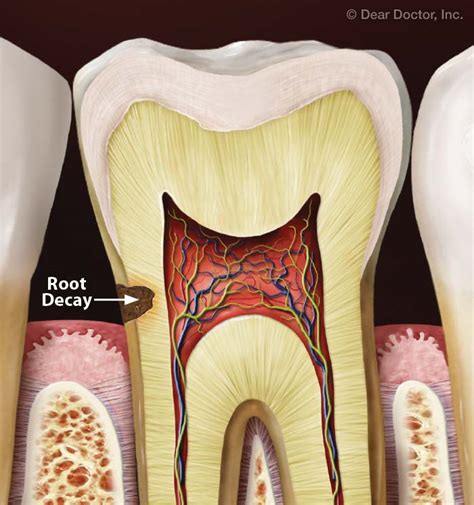 Having a tooth pulled in adulthood is if the tooth is impacted, the dentist will cut away gum and bone tissue that cover the tooth and then having a tooth pulled: How Long Does It Take To Get A Cavity