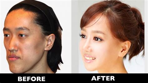 15 Korean Plastic Surgery Before And After Photos Youtube