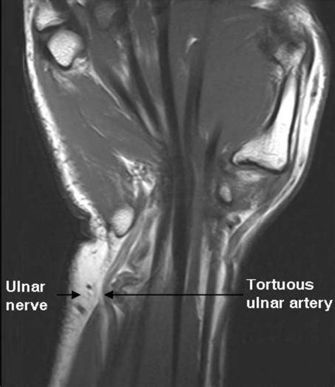 Coronal Mri Image Ulnar Nerve Compression In Guyon S Canal Due To