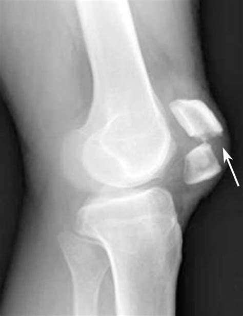Kneecap Fracture