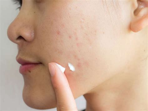 what are the best creams to remove acne scars begin 2 search