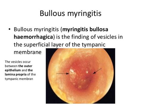 Miringitis