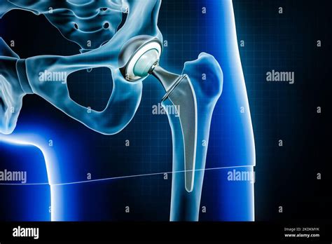 Femoral Head Hip Prosthesis Or Implant Total Hip Joint Replacement