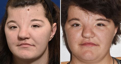 Plastic Surgery Case Study Forehead Reconstruction With