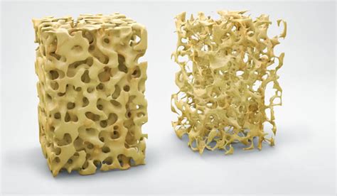 osteoporosis bones with holes