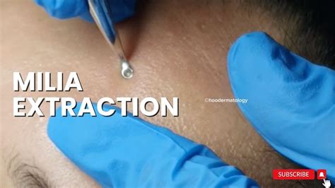 Milia Extraction On The Forehead Youtube