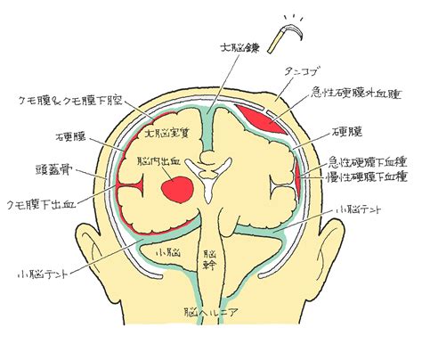 영어, 국어, 한자, 일본어, 중국어를 포함한 41종 언어 사전과 다양한 언어 학습 서비스 제공. 頭部外傷 外傷性くも膜下出血 | 福岡の弁護士による後遺障害 ...