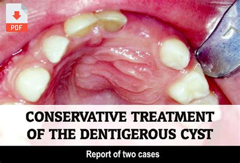 Pdf Conservative Treatment Of The Dentigerous Cyst Report Of Two Cases