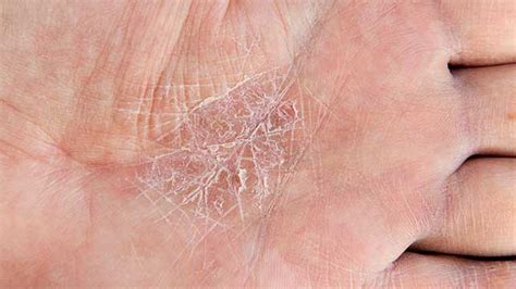 Eczema Definition Causes Treatments And Pictures