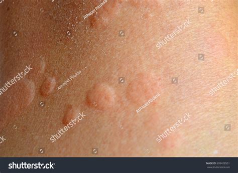 Itchy Hives Blister On Human Skin Stock Photo 699428551 Shutterstock