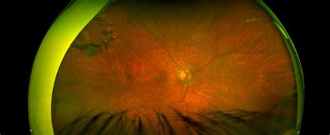 Retinal Holes Tears South Carolina Retina Institute Llc