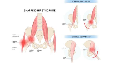 Snapping Hip Syndrome Dancers Hip