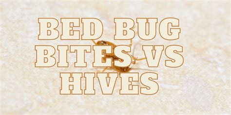 Bed Bug Bites Vs Hives How To Differentiate Between Them Bed Bugs World