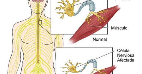 La esclerosis lateral amiotrófica afecta, tanto la primera como la segunda motoneurona que se ocupan de inervar los músculos voluntarios. Las enfermedades mas peligrosas : Esclerosis Lateral Amiotrófica