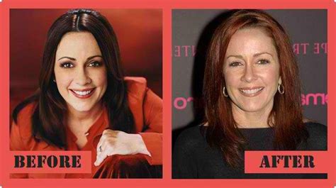Patricia Heaton Plastic Surgery Before And After With Images
