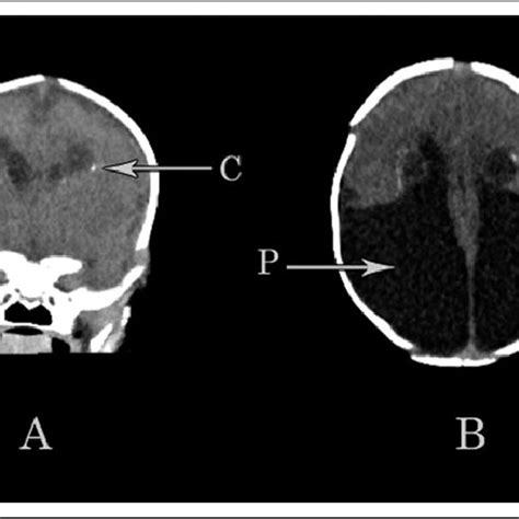 Figure A Noncontrast Frontal A And Axial B Computed Tomography Of