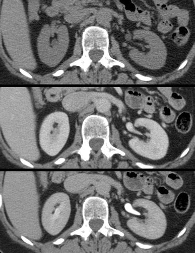 Ct Urography For Evaluation Of The Ureter Radiographics