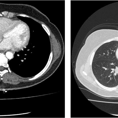 Contrast Enhanced Thorax Ct Showed Hypodense Soft Tissue Lesion In The