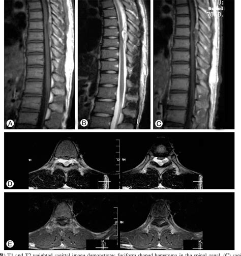 Figure 1 From Spontaneous Spinal Epidural Hematoma Of The Thoracic