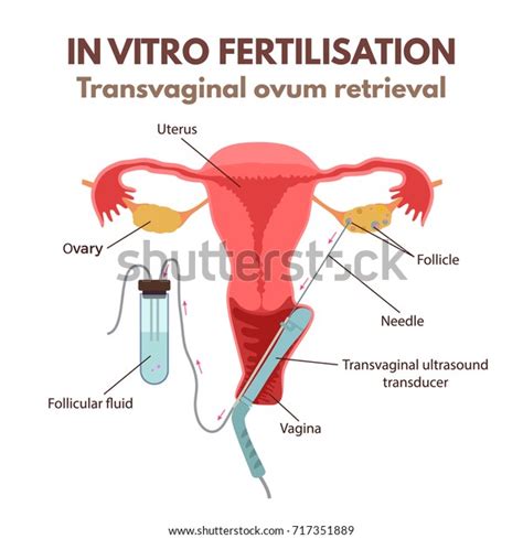 Método de fertilización in vitro vector de stock libre de regalías Shutterstock