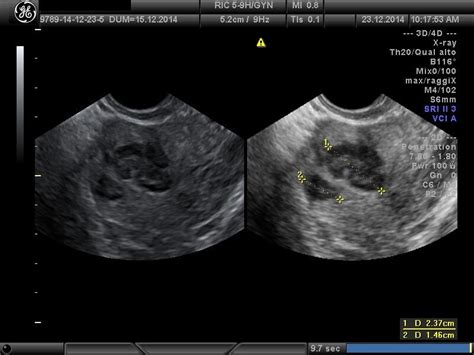 The Ultrasound View Of Submucosal Uterine Fibroid Ultrasound View Of
