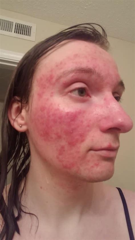 [skin concerns] persistent redness on face worsened after hot shower r skincareaddiction