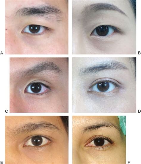 The epicanthic eye fold #soc119. Asian eyelid morphologies are categorized into six types ...