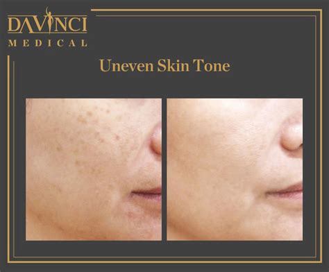 Da Vinci Clinic Skin Brightening And Toning Rejuvenation Treatment