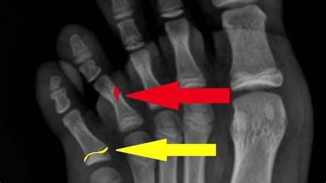 4th And 5th Toes Fractures Xray 35 Youtube