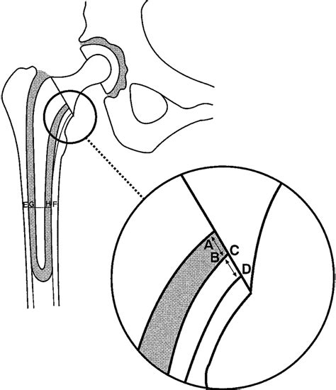 Diagram Of A Total Hip Replacement Showing The Position Of The