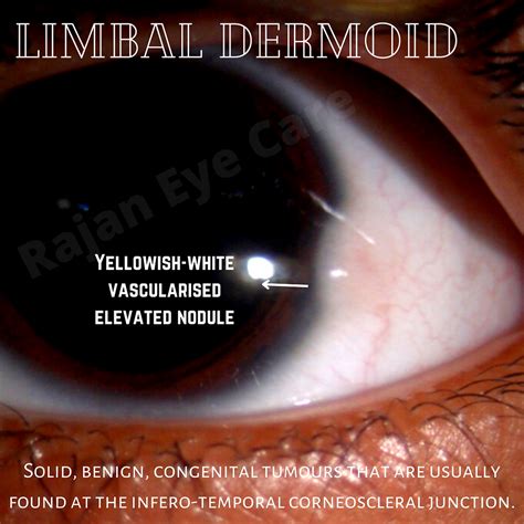 Congenital Limbal Dermoid And Its Grading