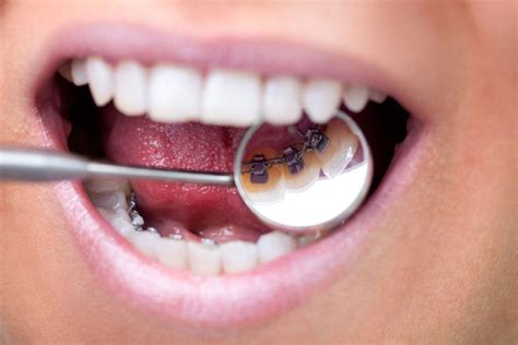 Common Problems With Diy Teeth Whitening Dental Visalia