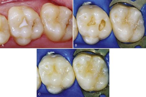 10 Class I Ii And Vi Direct Composite Restorations And Other Tooth