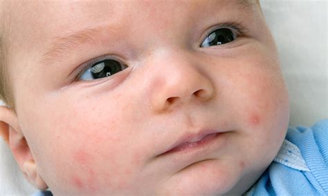 Baby And Newborn Acne Causes And Treatment Pampers Uk