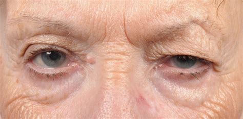 Dry Skin On Eyelid Pictures Photos