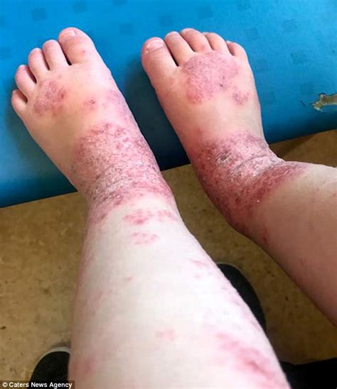 Toddler Was Covered In A Rash After A Virus Entered Via A Scratch All