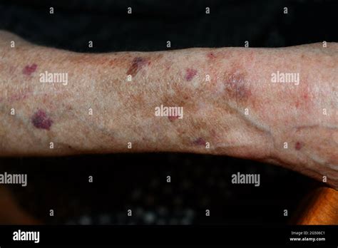 Skin Bruising Hi Res Stock Photography And Images Alamy