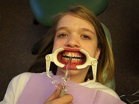 11 Problems Braces Gave You That Youre Now Thankful For In College