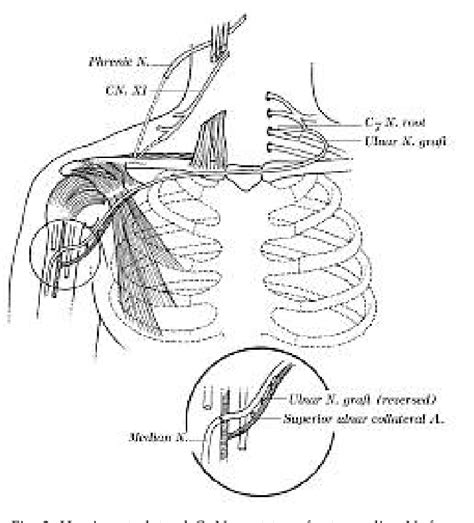 Figure 2 From Management Of Brachial Plexus Injury In Adults Semantic