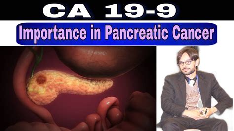 Ca 19 9 Test Pancreatic Cancer Screening Youtube