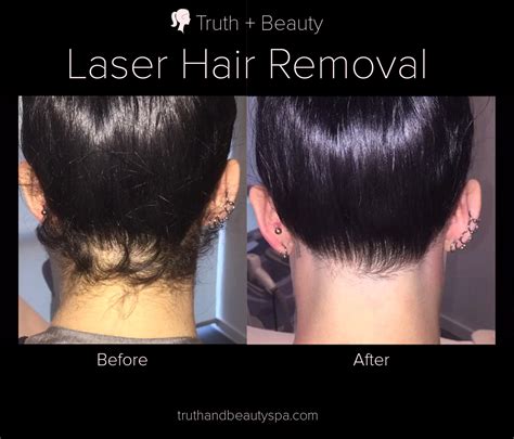 Laser hair removal neck before and after. Laser Hair Reduction in New York - Truth + Beauty Spa