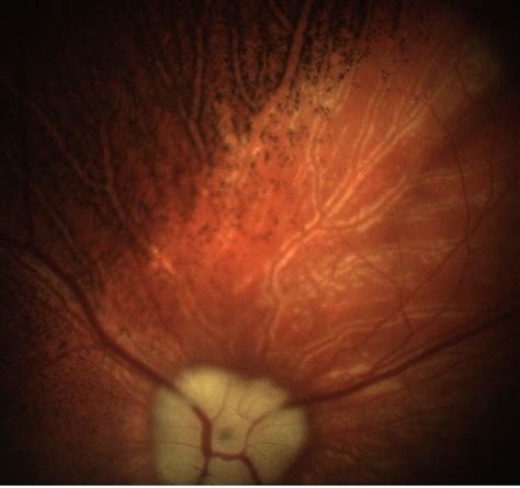 Retinal Imagery Epipole Veterinary