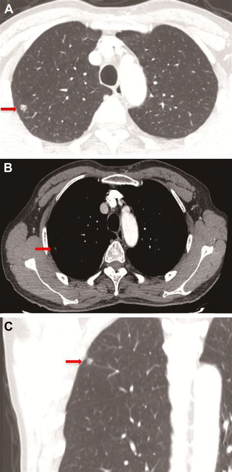 Chest CT Scan Notes A Lung Window B Mediastinal Window C