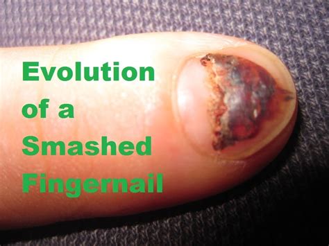 Evolution Of A Smashed Fingernail Youtube