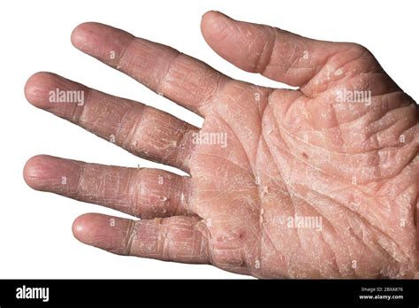 Dermatite Atopique Corticost Ro Des Banque De Photographies Et Dimages