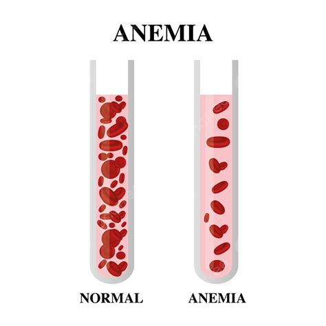 Anemia Iron Red Blood Cell Medical Vector Illustration Anemia Blood