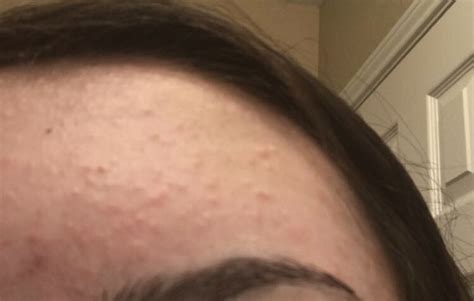 Folliculitis On Face Treatment Doctor Heck