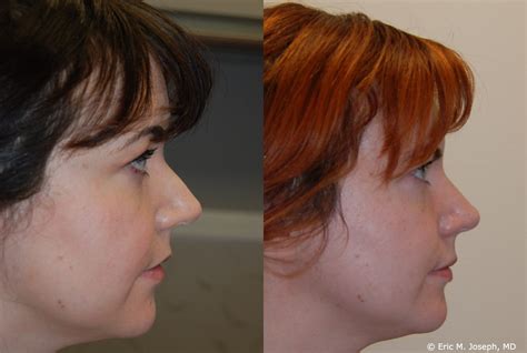 Eric M Joseph Md Silikon 1000 Before And After Non Surgical Rhinoplasty